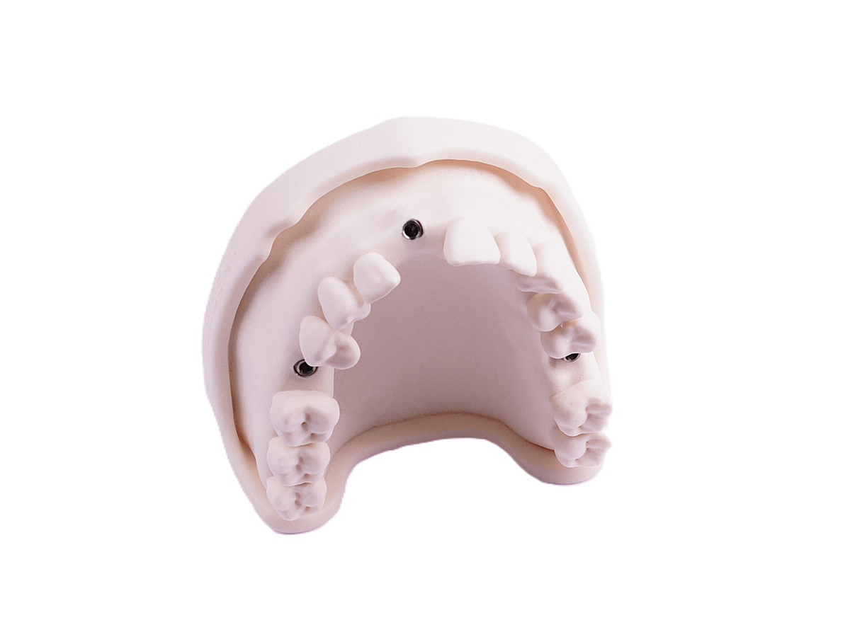 Periodontologijos modelis EduDent – periimplantitas, 1 vnt.